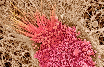 Image: Colored scanning electron micrograph (SEM) of part of a squamous cell carcinoma cell (Photo courtesy of Steve Gschmeissner / SPL).